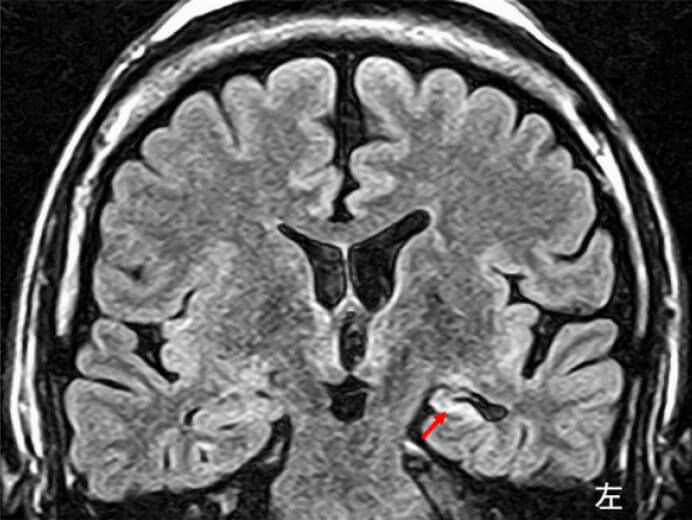 巨脳症のリスクがあるのは誰ですか?